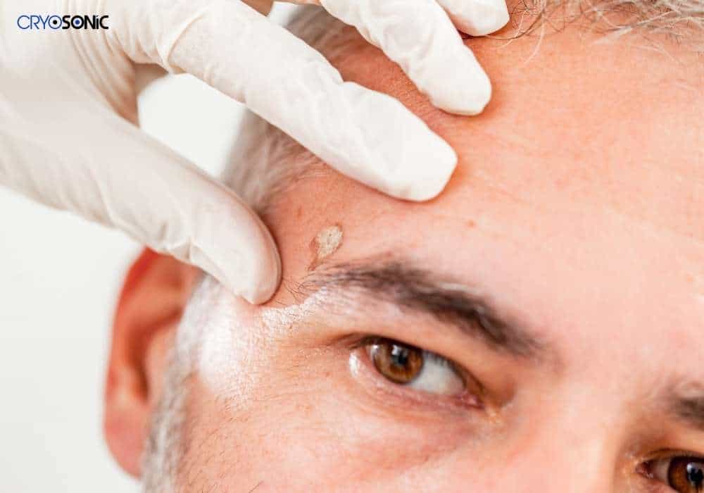 Cryopen Treatment Haydock Haydock