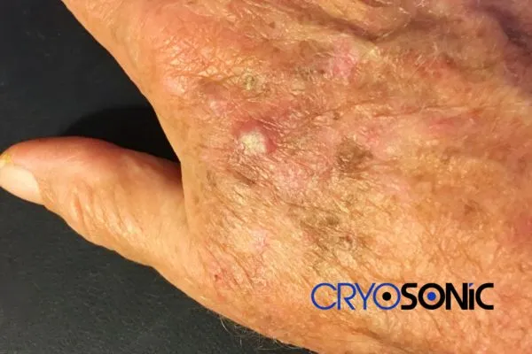 Book Your Actinic Keratosis removal Haydock treatment Today Haydock