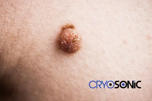 Are you looking for local Dermatofibroma Removal Bristol? Contact our team today in Haydock
