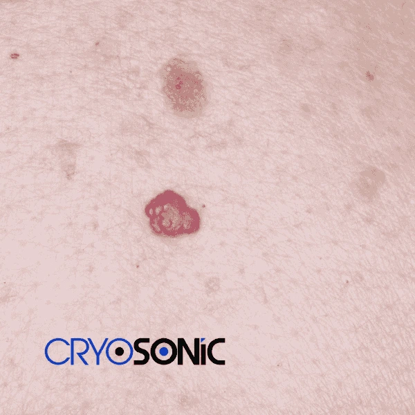 Looking for pain free cherry angioma removal treatment Haydock? Call our team today! Haydock