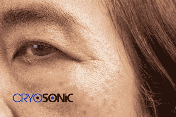 Start age spots removal Haydock treatment today! Call our team now! Haydock