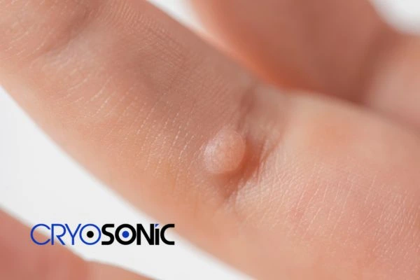 Contact Cryosonic today to learn more about us Haydock now! Haydock