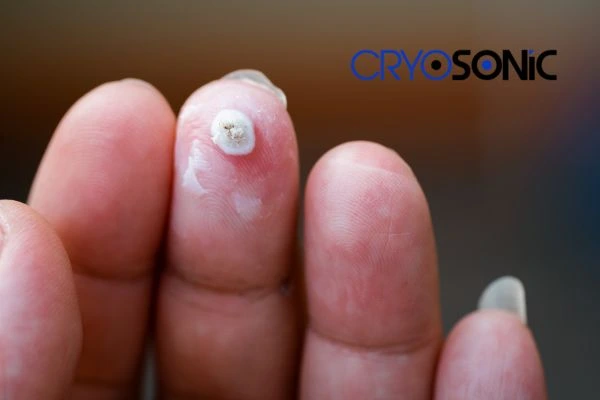 Learn more about us Haydock at Cryosonic. Book in today! Haydock