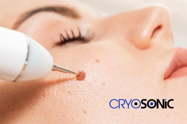 why choose us at Cryosonic for blemish removal? Find out more now Haydock
