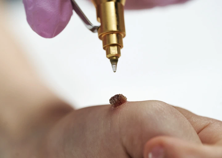 Cryopen For Children Bristol Haydock