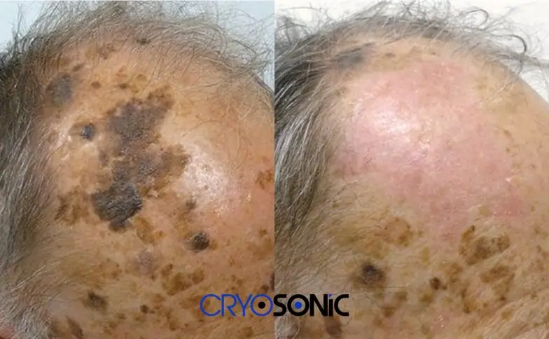Seborrhoeic Keratosis Removal before and after Haydock