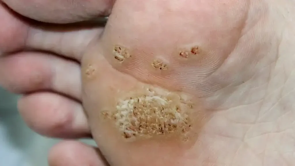 Secure Your Wart Removal Appointment with One Click Haydock