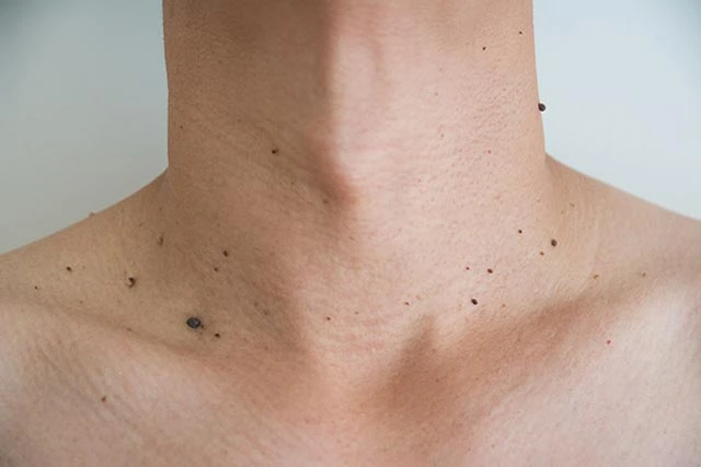 What to Avoid After Benign Mole Treatment in Haydock Haydock