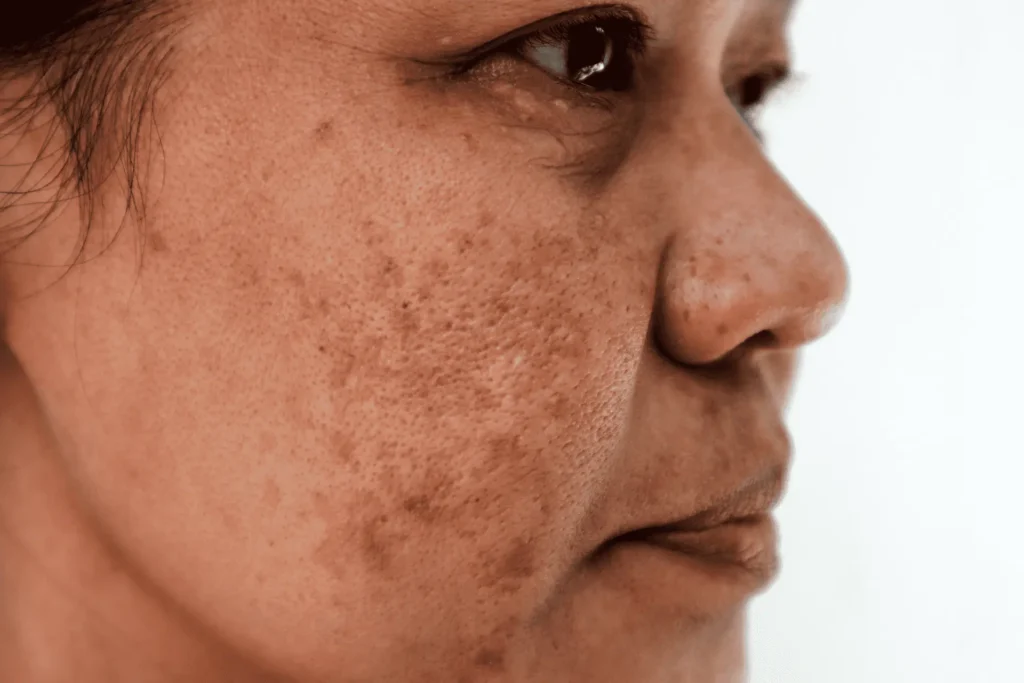 Aftercare Advice for Sun Damage Treatment Haydock