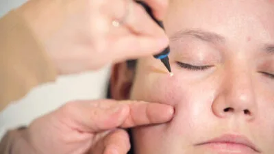 Aftercare Advice Following Milia Removal in Haydock
