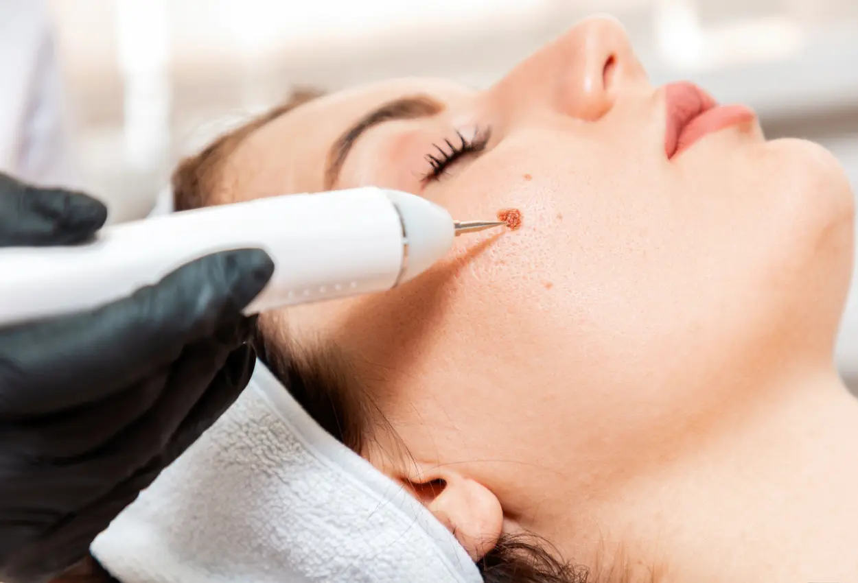 Frequently Asked Questions About Multiple Cryotherapy Treatments Haydock