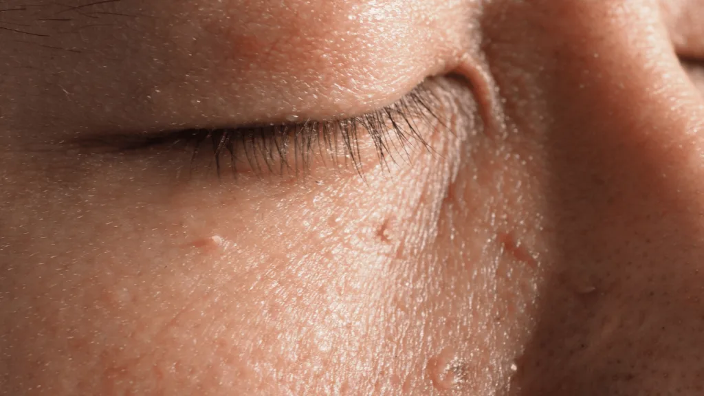 Frequently Asked Questions about Skin Tag Removal Haydock