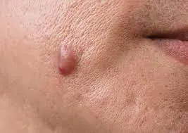 Skin Tags Recovery Time and Skin Healing Expectations Haydock