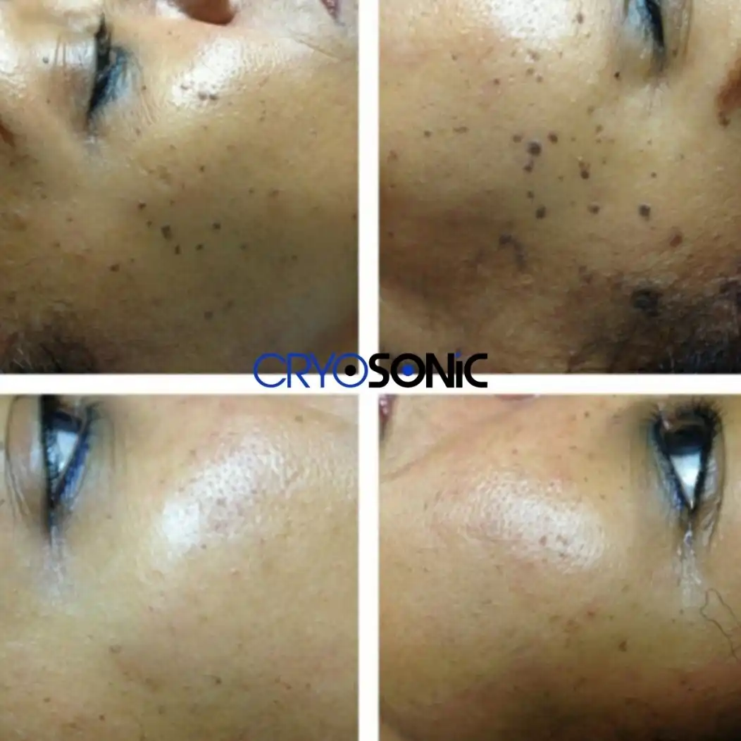 Why Skin Shows Pigmentation After Treatment Haydock