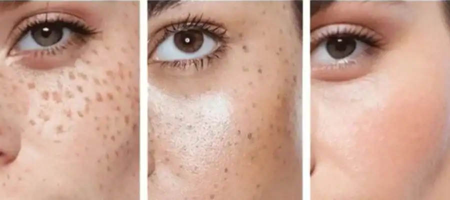 Ephelides Removal Results and Healing Timeline Haydock