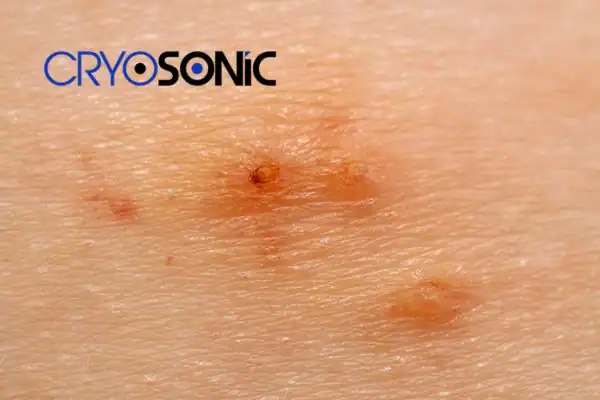 Image of Molluscum Contagiosum Treatment Haydock Haydock