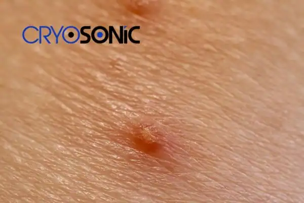 Molluscum Contagiosum Treatment Haydock Haydock