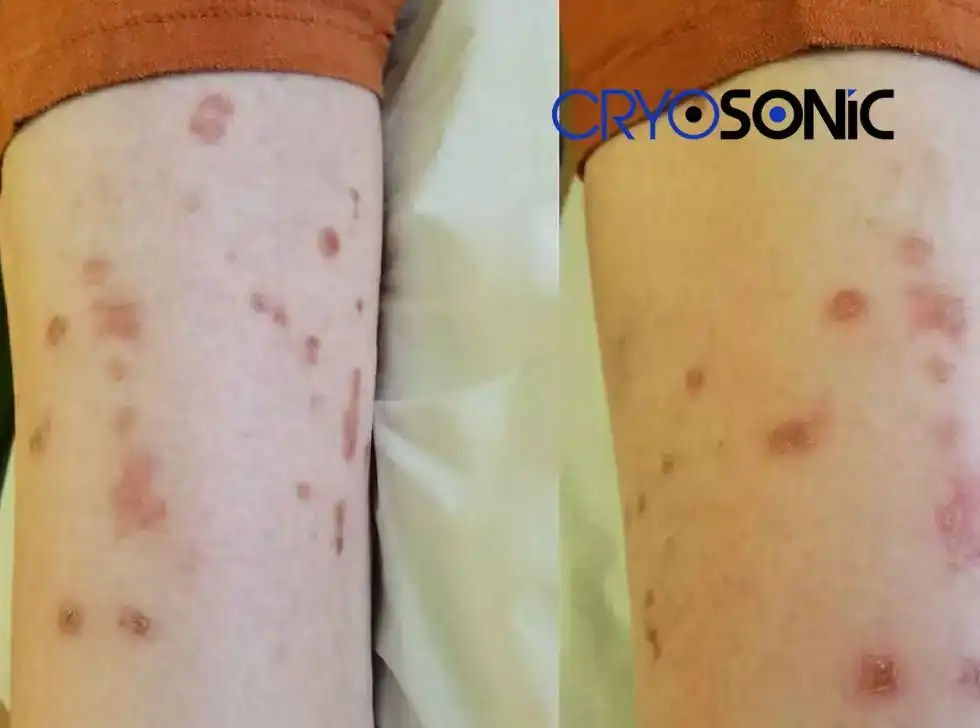 Recovery and Aftercare for Porokeratosis Treatment Haydock Haydock