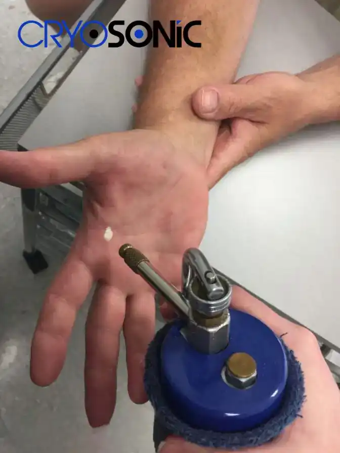 Temperature Differences: OTC vs Medical-Grade Cryotherapy Haydock